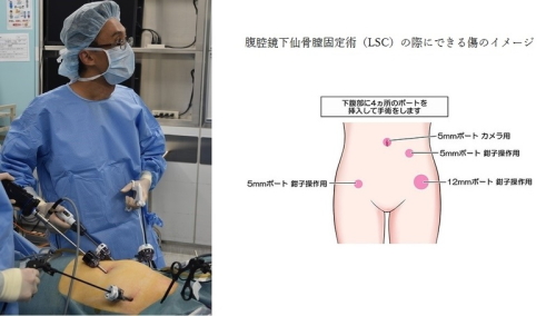 石川先生が実際に腹腔鏡下仙骨膣固定術（LSC）を行う様子とLSCの際にできる傷のイメージ